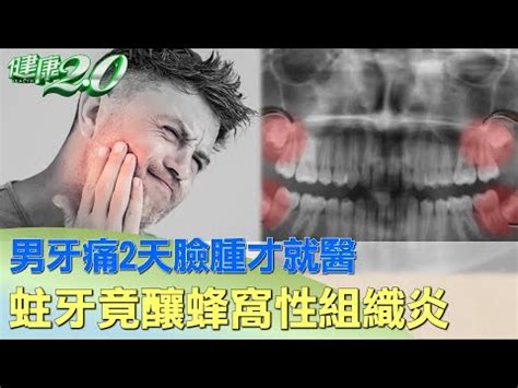 牙痛臉腫怎麼消|牙齦腫脹、發炎多久會好？6招有助改善牙齦腫痛問題…